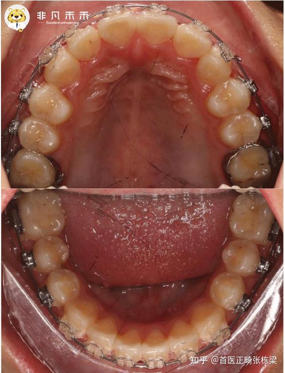不拔牙矫正排齐严重牙齿拥挤一例