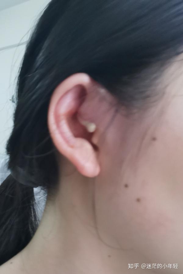耳前瘘管发炎 治疗