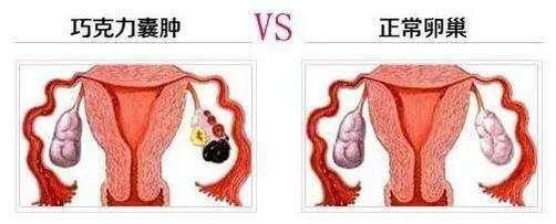 怎么有效预防巧克力囊肿