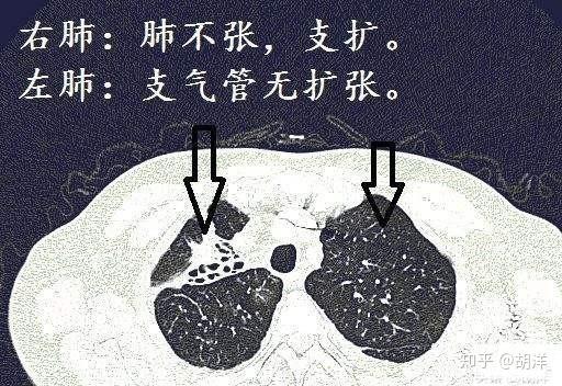 支气管扩张每天吐不完的痰液从哪里来,一招可以控制痰多,不花钱