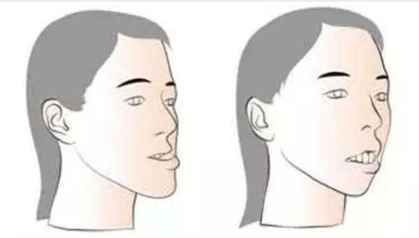 牙齿矫正能改变脸型先来看看地包天矫正后的脸型变化