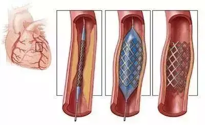 心脏支架手术过程