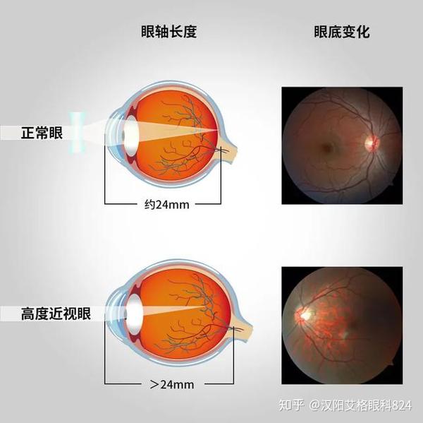 配戴眼镜是为了对近视进行矫正,不戴眼镜只会让眼睛始终