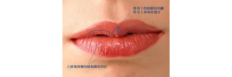 你知道吗做了m唇以后改善的不仅仅只是美观哦