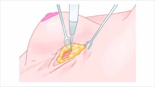 乳腺手术切口选择及效果分析