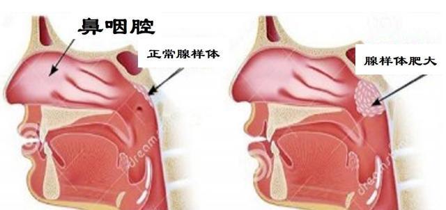 鼻咽癌的早期症状与就诊建议