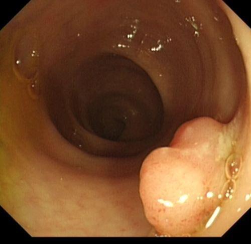 凌方殿:大肠息肉——明确的癌前病变