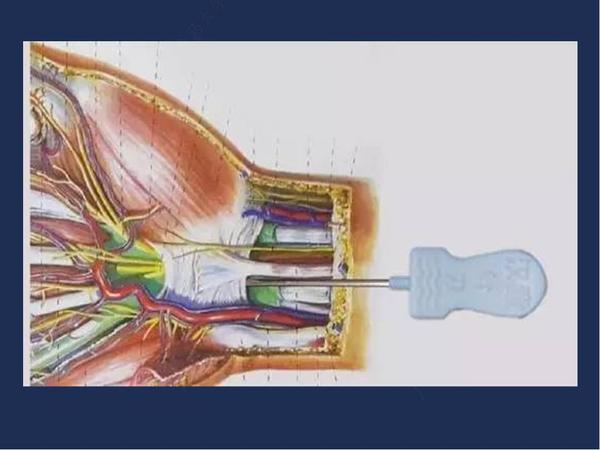 腕管综合征针刀治疗