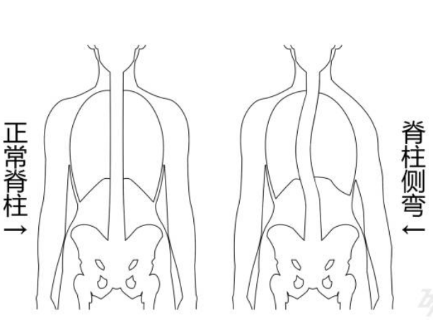 脊柱侧弯的基础知识