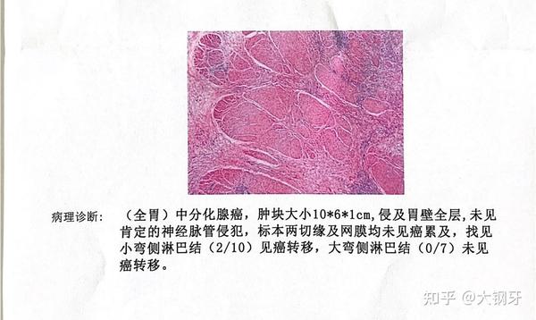 胃癌病理终于出来了