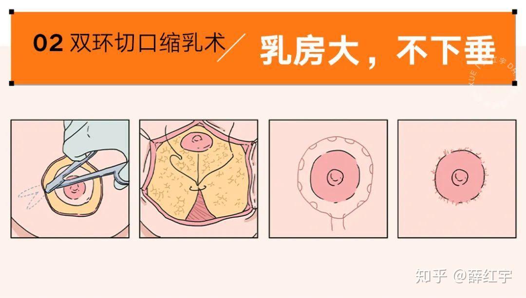 该方法的好处是无切口,不去皮,只在两侧腋窝附近各有一个针眼痕迹.