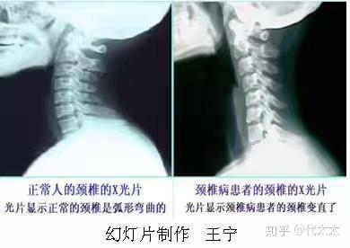 如何矫正脖子前倾