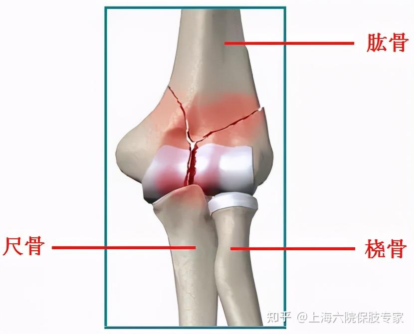 「病例精选」肘关节骨折orif术后感染,内固定物取出还是保留?