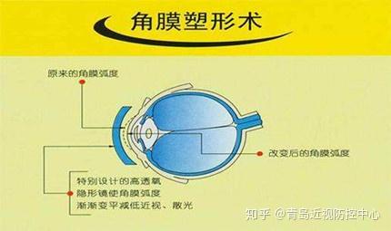 塑形镜戴久了会让角膜变薄?影响以后进行近视激光矫正
