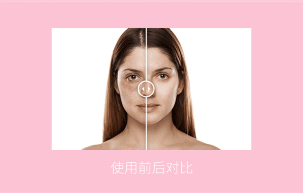 想要祛斑彻底,激光祛斑是不错的选择