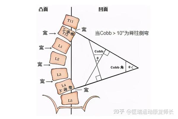 cobb角10°-20°:除以上方法外,加用侧方电刺激 cobb角20°-40°