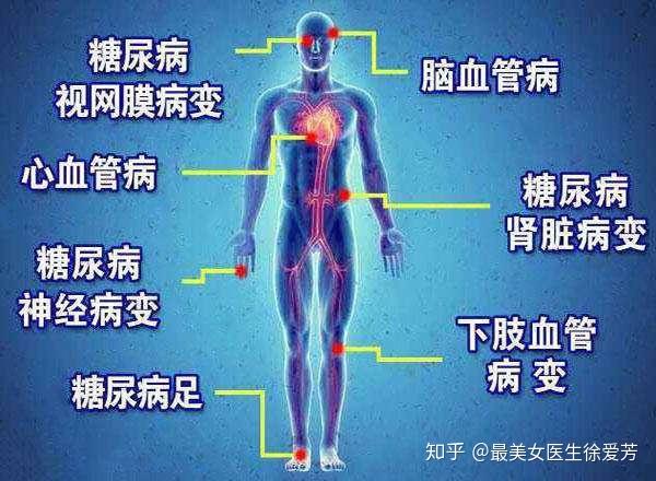 预防大于治疗糖尿病让人苦不堪言提早把血糖控制达标