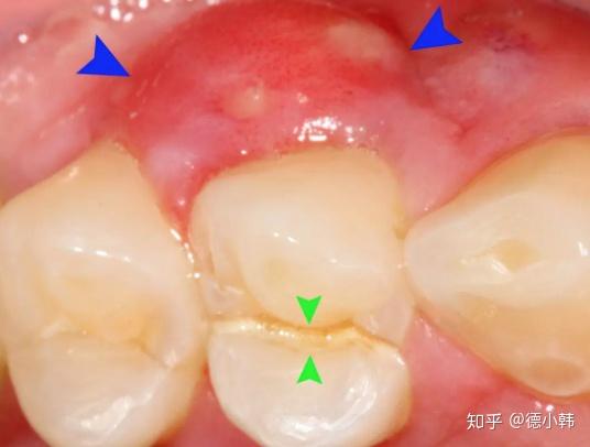 有坏牙→可能牙槽脓肿01牙龈上的小脓包怎么起来的?