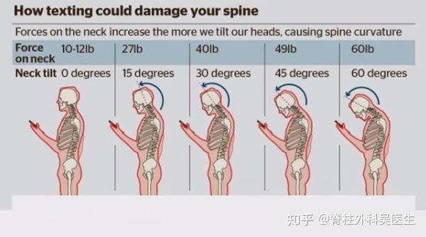 颈椎生理曲度变直——对低头族颈部疼痛的一种严重警告