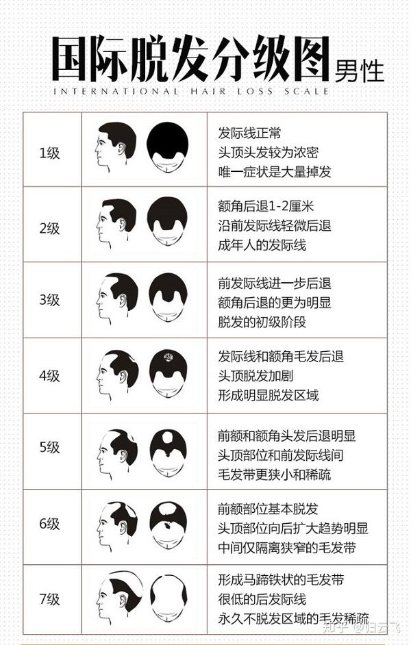 男性型脱发用什么药?