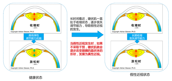 科普丨中国青少年近视率世界第一青少年应如何保护视力恢复睫状肌的