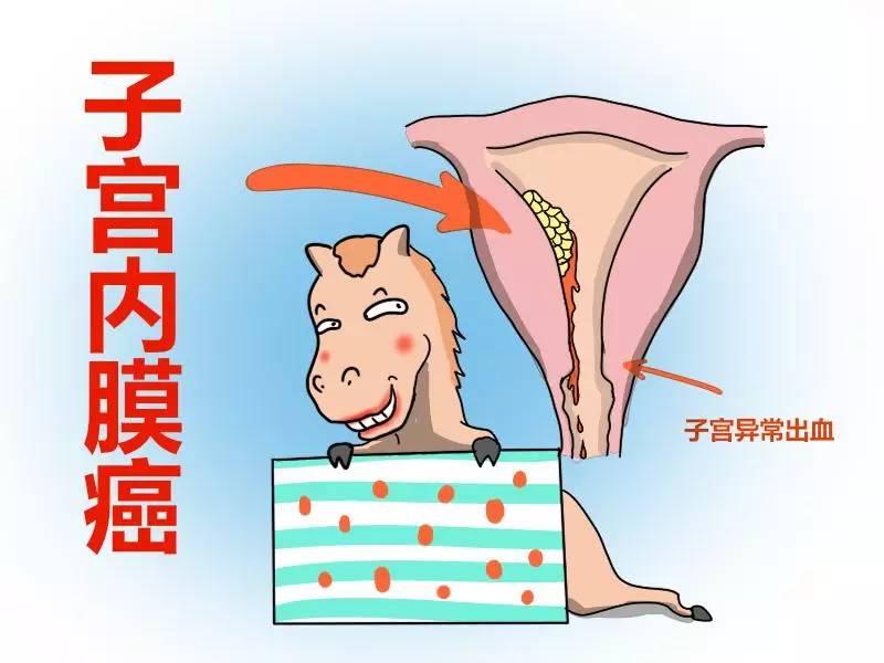 年纪大的女士要小心子宫内膜癌