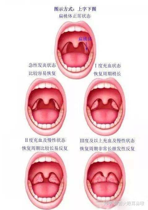 首大石萍扁桃体发炎会怎样