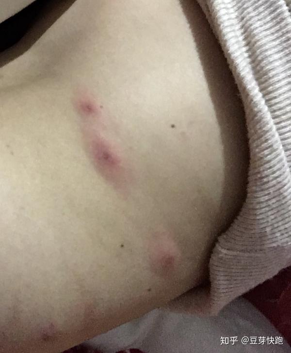 是什么引起的丘疹性荨麻疹?