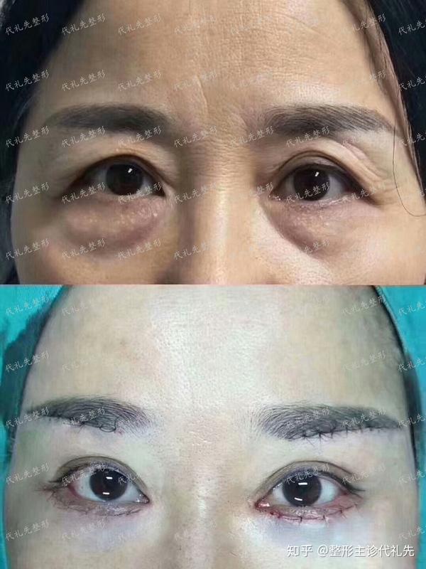 祛眼袋案例  提眉 祛眼袋 从术前的照片可以依稀看到女士年轻时的样子
