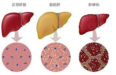 脂肪肝的定义,检查与核保