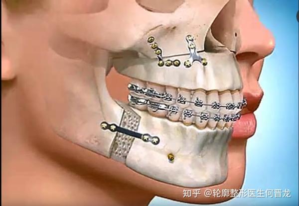 从外观上看嘴巴是前突的,实际是由于下颌骨发育不良所致.