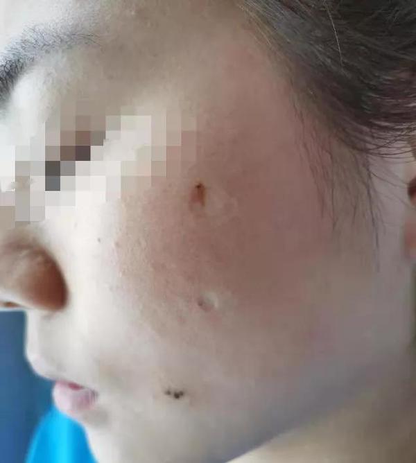 一般有两种方案: 一,"点"痣 对于直径2mm以内的痣,可以二氧化碳激光