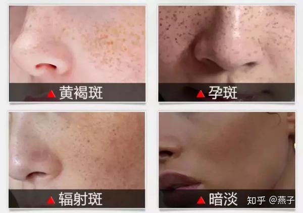 3,黄褐斑