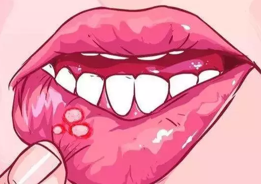 经常口腔溃疡怎么办看这篇就够了