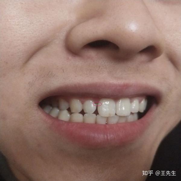 大门牙看的不是很清楚就跟旁边的牙齿黑点隔着