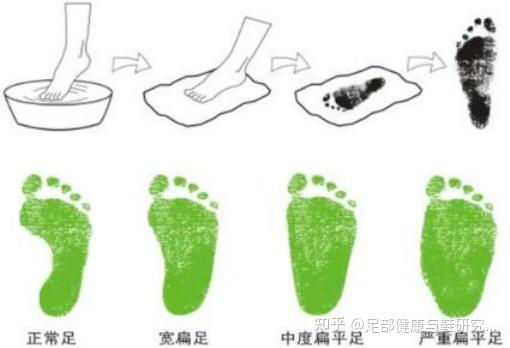 足部健康无大小,科学认识扁平足进行"自救"