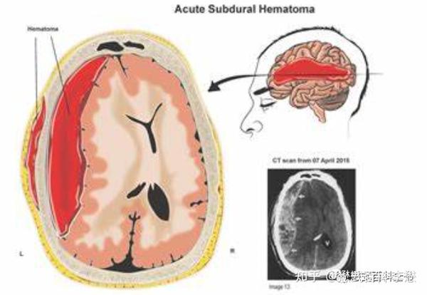 图8,9:硬膜下血肿示意图