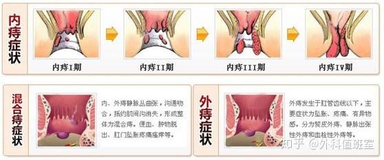 大部分痔疮早期发作的患者也会存在着非常明显的便秘症状,而且越发作