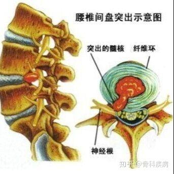 椎间孔镜与椎间盘镜手术有啥区别,哪个好?