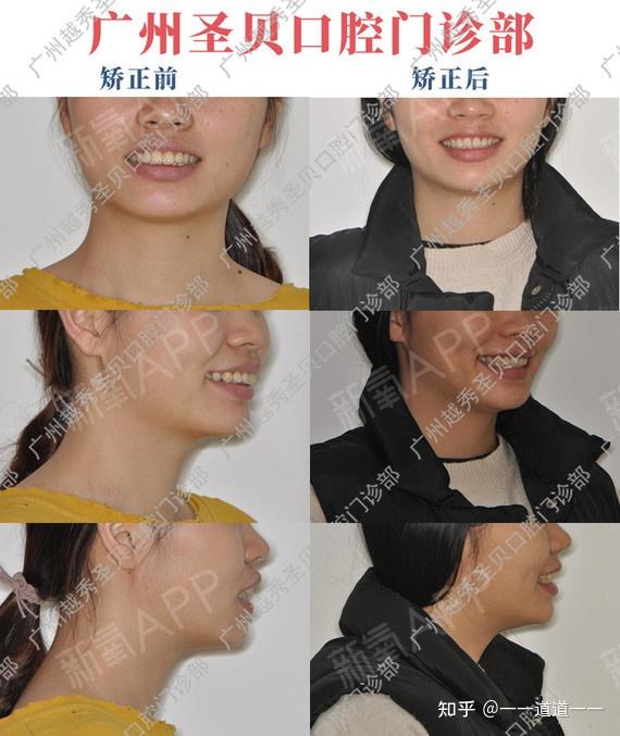 广州圣贝牙齿矫正案例分享:深覆合 凸面型矫正案例