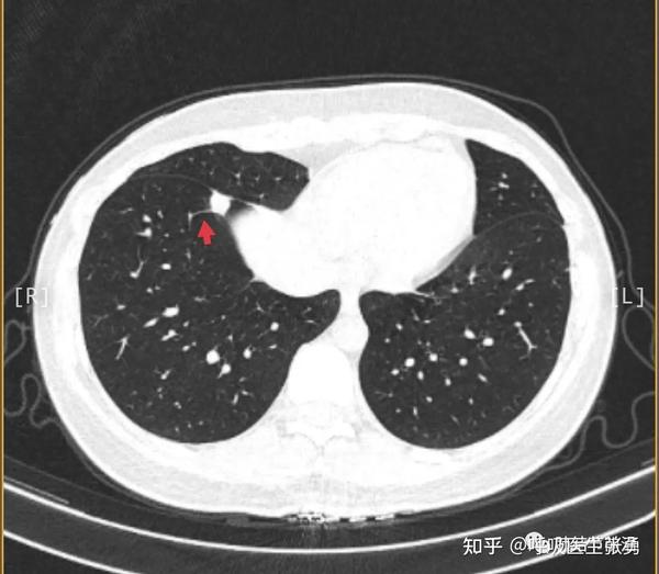 肺结节读片(21):鉴别11mm的实性结节良恶性的技巧