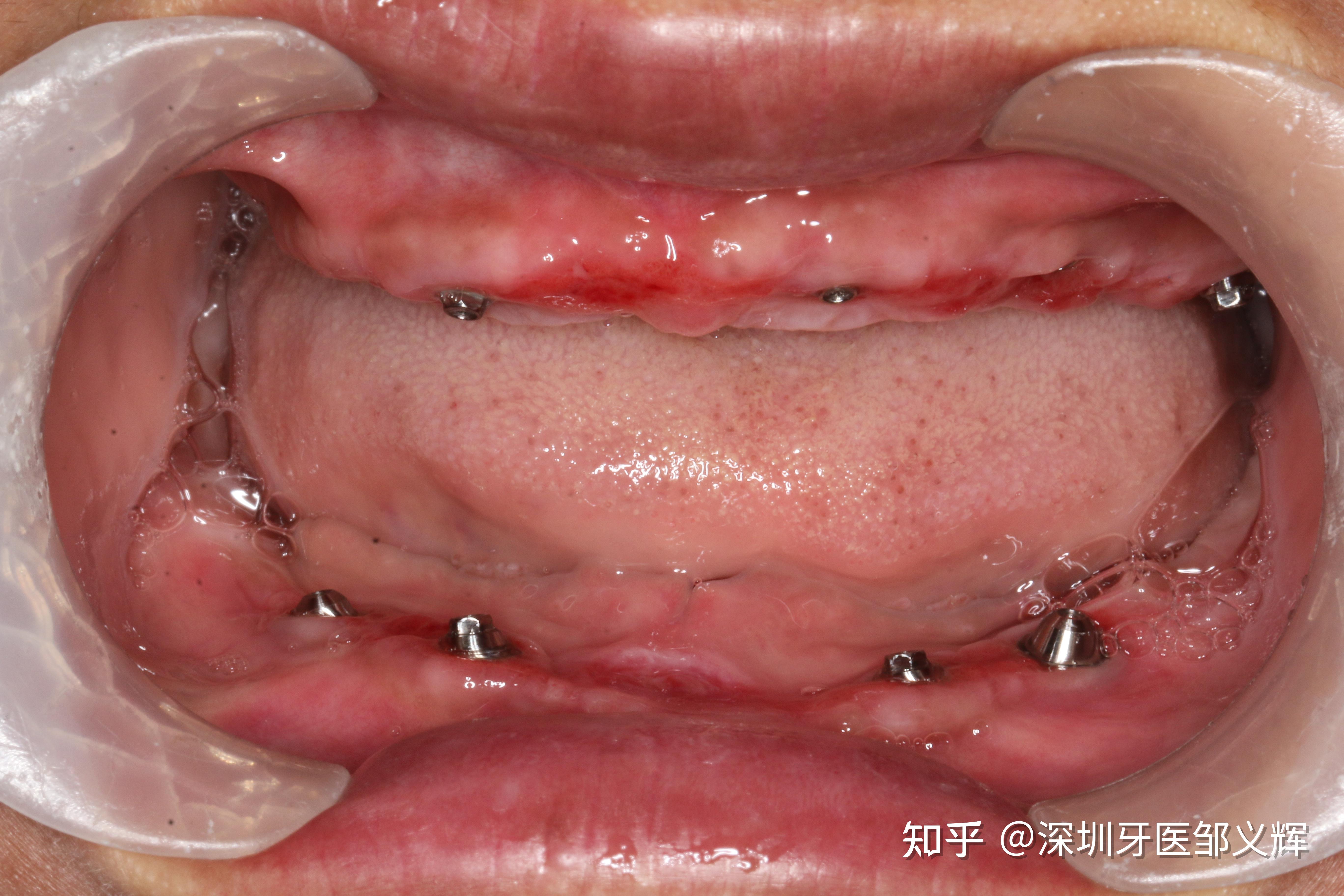 无牙颌修复一例