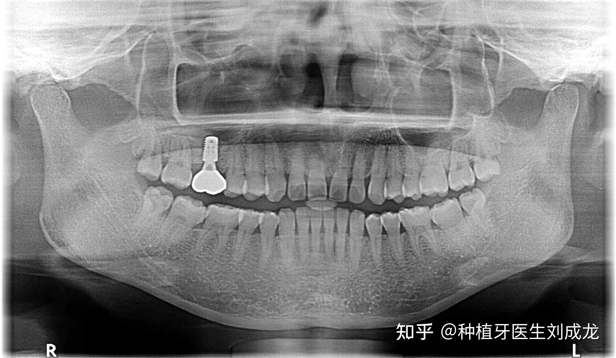 郑州瑞士iti种植牙医生刘成龙磨牙区单颗种植修复案例
