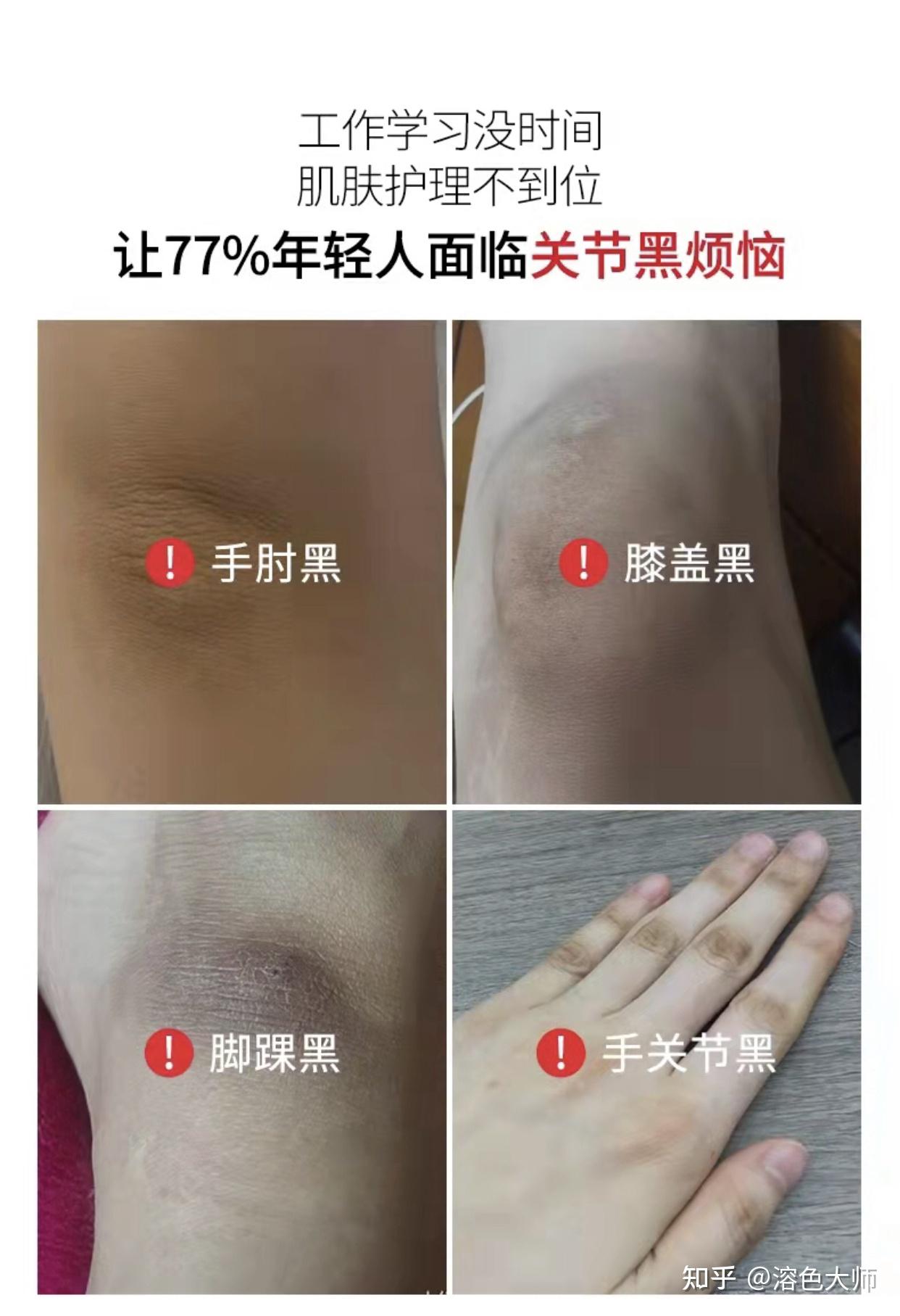 想了解下关节黑色素沉淀怎么去除