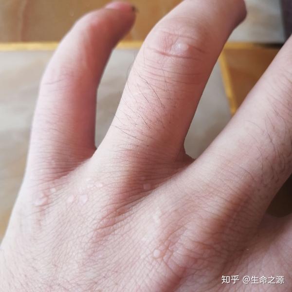 手上长这种疙瘩和生殖器冠环 有倒刺 也有一个小疙瘩.这是尖锐湿疣吗?