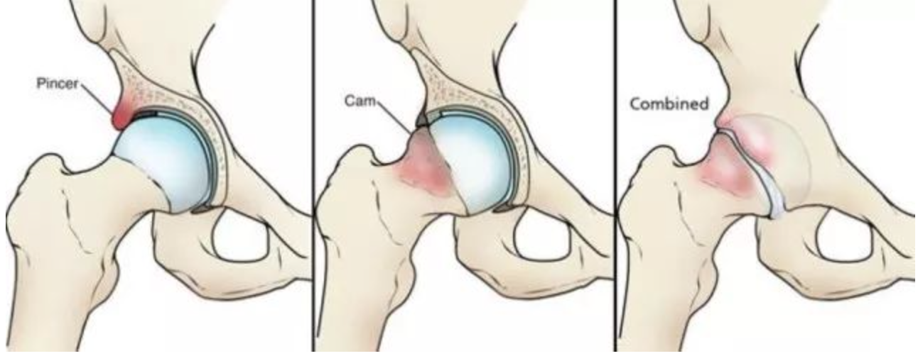 今天和大家聊一聊让很多患者十分困扰的两个问题——髋关节盂唇损伤
