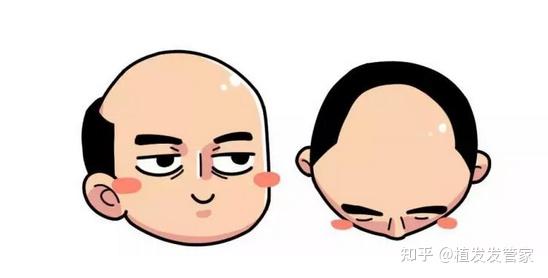 为什么脱发的人大多都是额角m型发际线