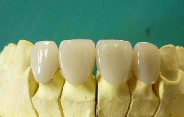 临时牙套已戴一个月,基牙根部变色,装全瓷牙怎样处理?