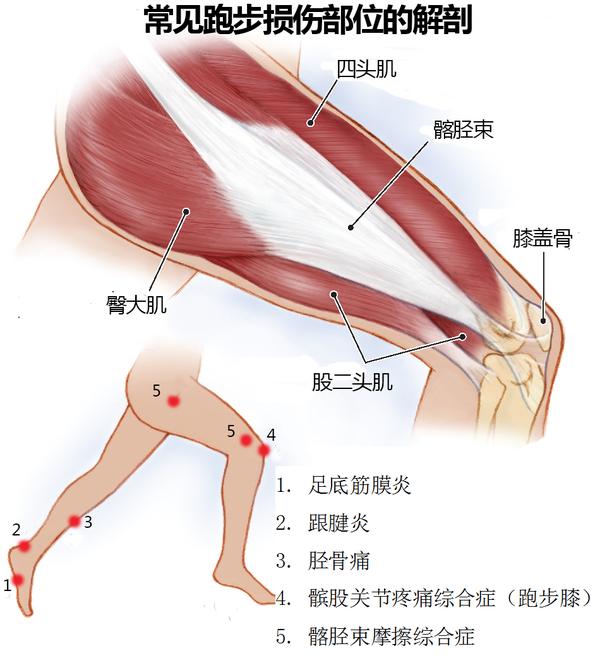 一,足底筋膜炎