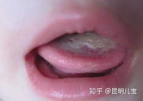 很心疼,宝宝得了鹅口疮怎么办?